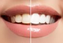 Teeth Whitening Courses