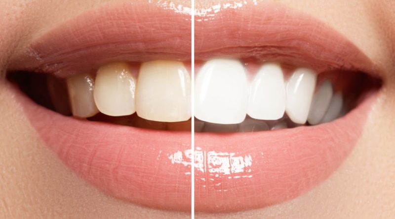 Teeth Whitening Courses